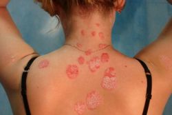 Odamlarda trikofitoz