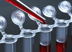 Qondagi atipik mononukulyar hujayralar