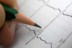 Yurak aritmiyasi - sabablari va belgilari